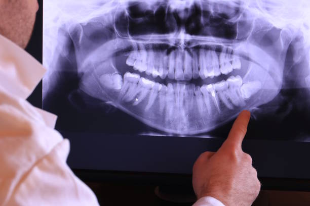 Best Emergency Wisdom Tooth Extraction in Palos Heights, IL
